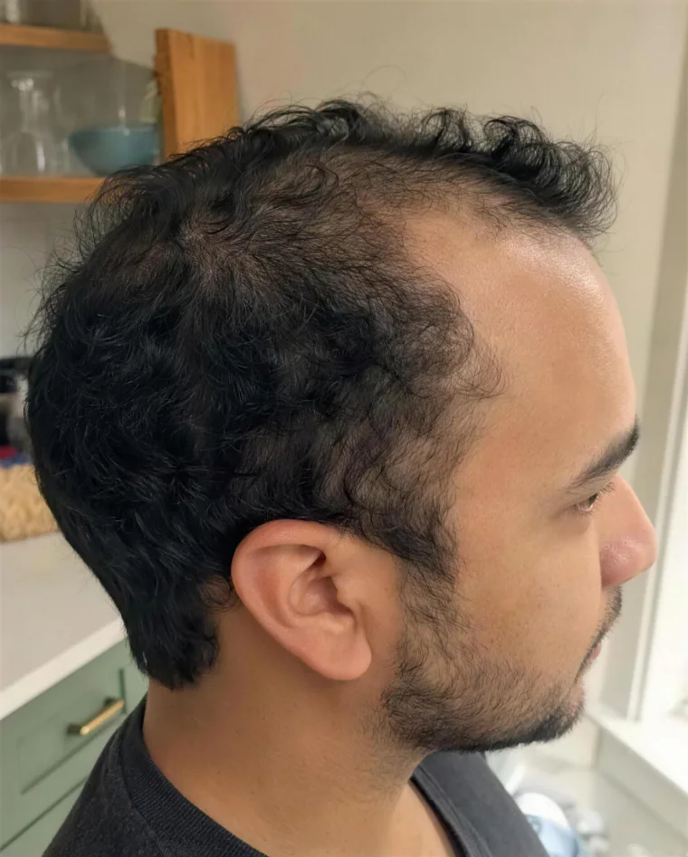 Chris M., before