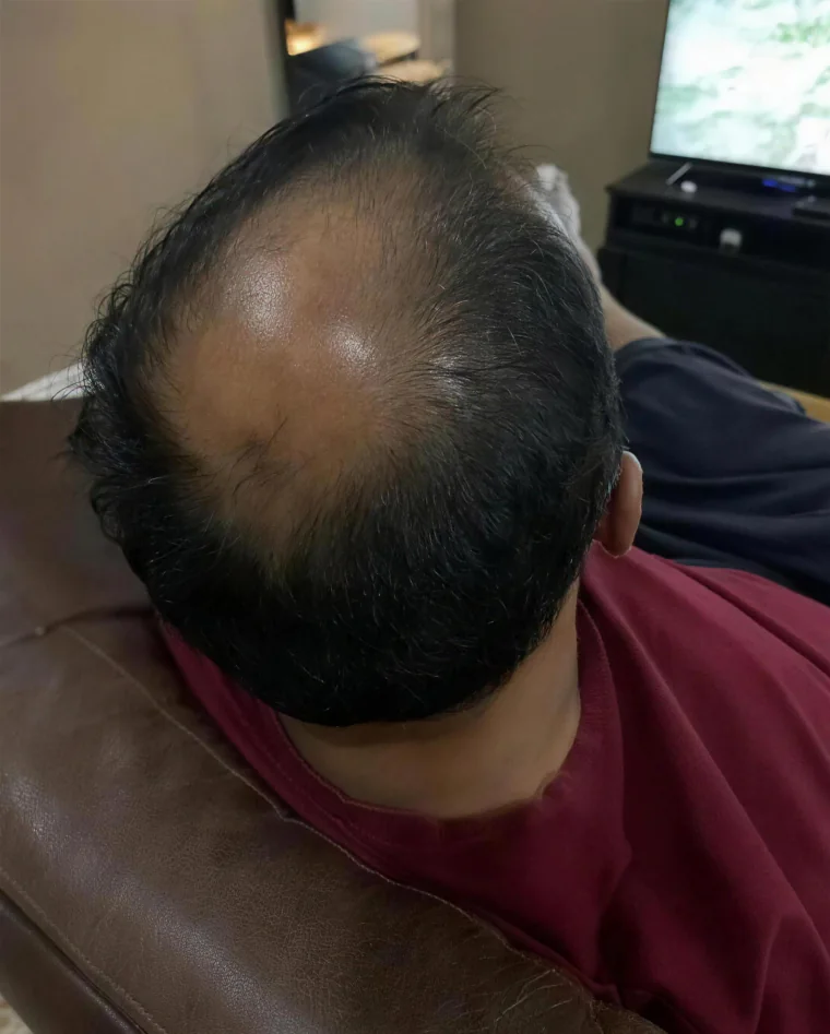 Raj P., before